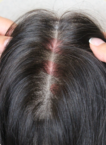 Topo Capilar Full Lace 1